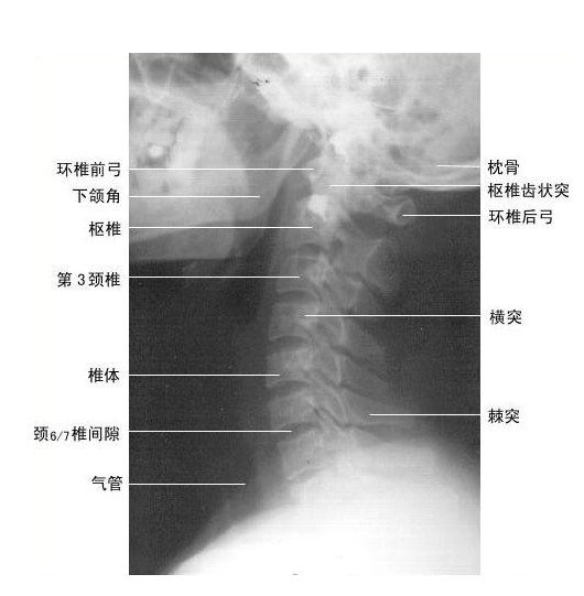 临床助理医师考试辅导:X射线-颈椎侧位(图)\/考