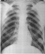 医师呼吸系统重要考点总结:第八单元肺结核\/考